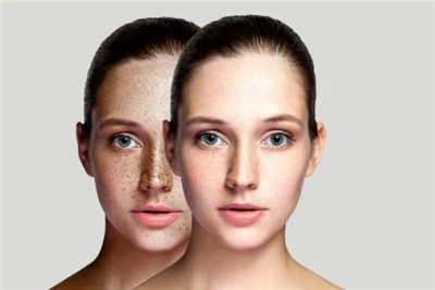 Fractional CO2 Laser Skin Resurfacing: The Ultimate Guide To Laser Skin Rejuv...